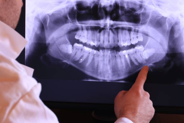 Best Knocked-Out Tooth (Avulsed Tooth) Treatment in Dimmitt, TX